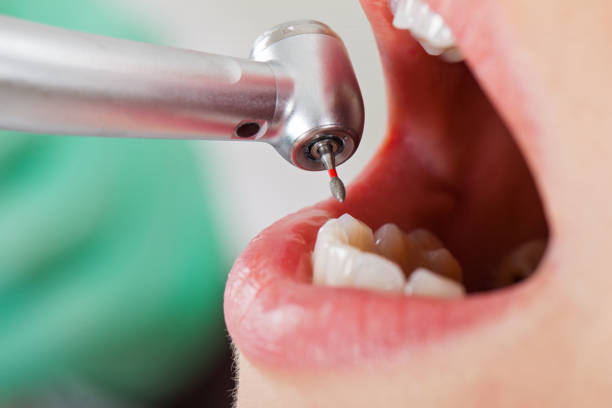 Best Emergency Root Canal Treatment in Silver Hill, MD